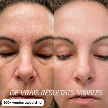 BIOALEN™ - Stick Repulpant Bio-Collagène PDRN